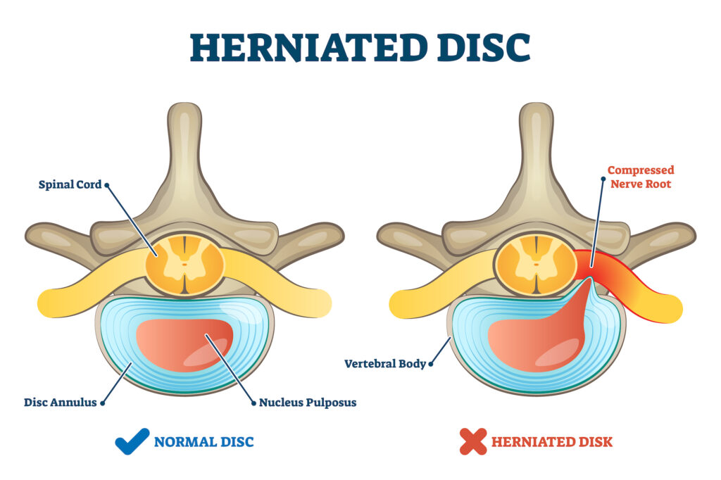 What Is a Herniated Disc and What Can You Do If You Have One? -  Chiropractic Health and Wellness