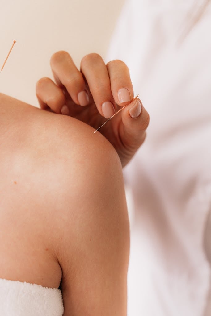 Close-up of acupuncture needle therapy on a patient's shoulder illustrating alternative medicine.