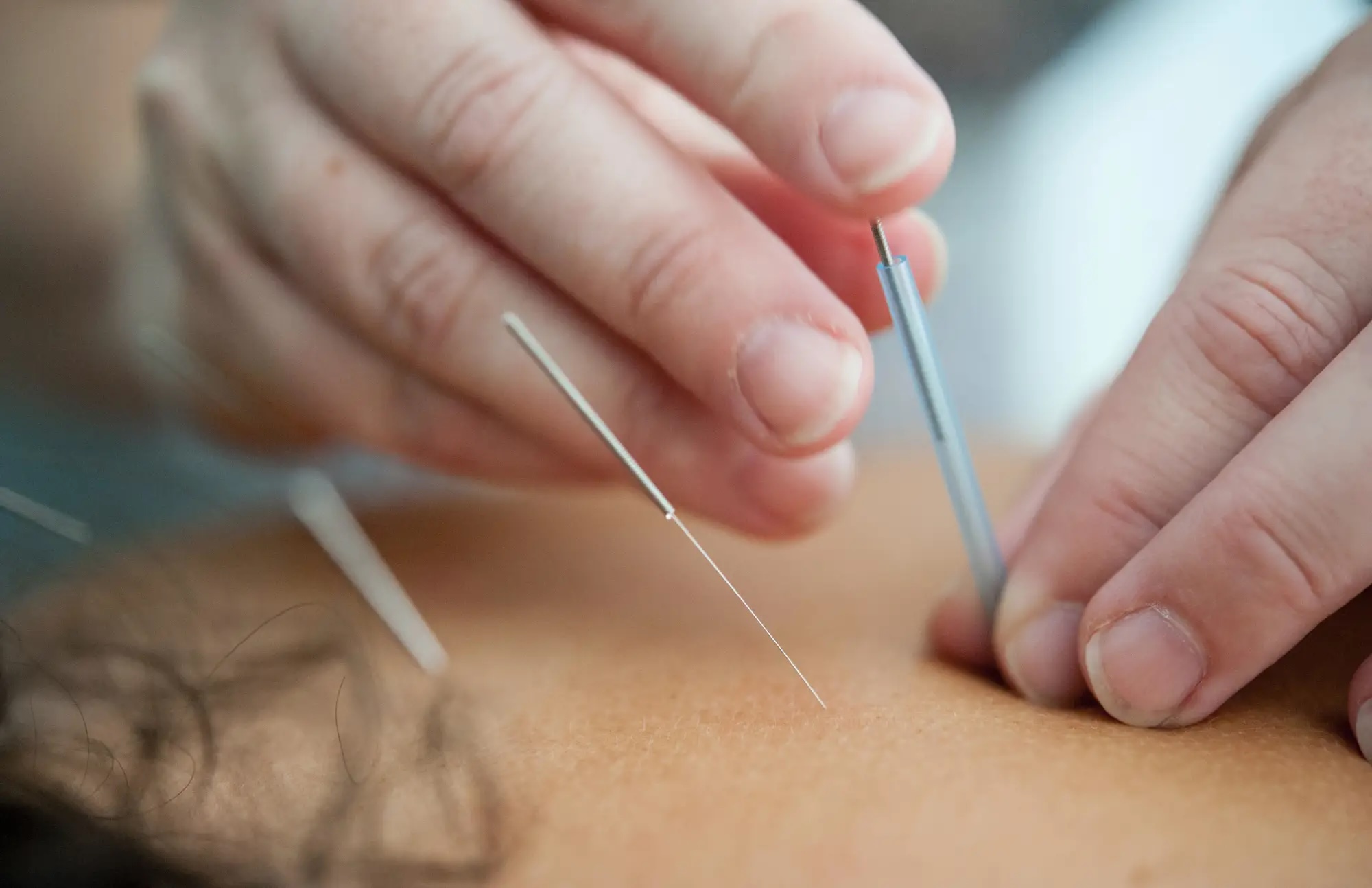 acupuncture therapy coquitlam