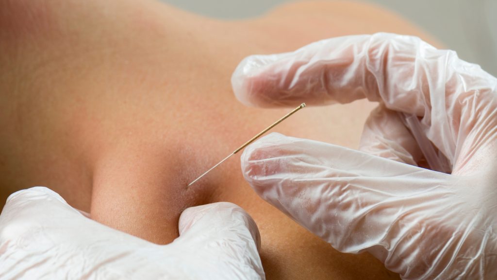 IMS dry needling