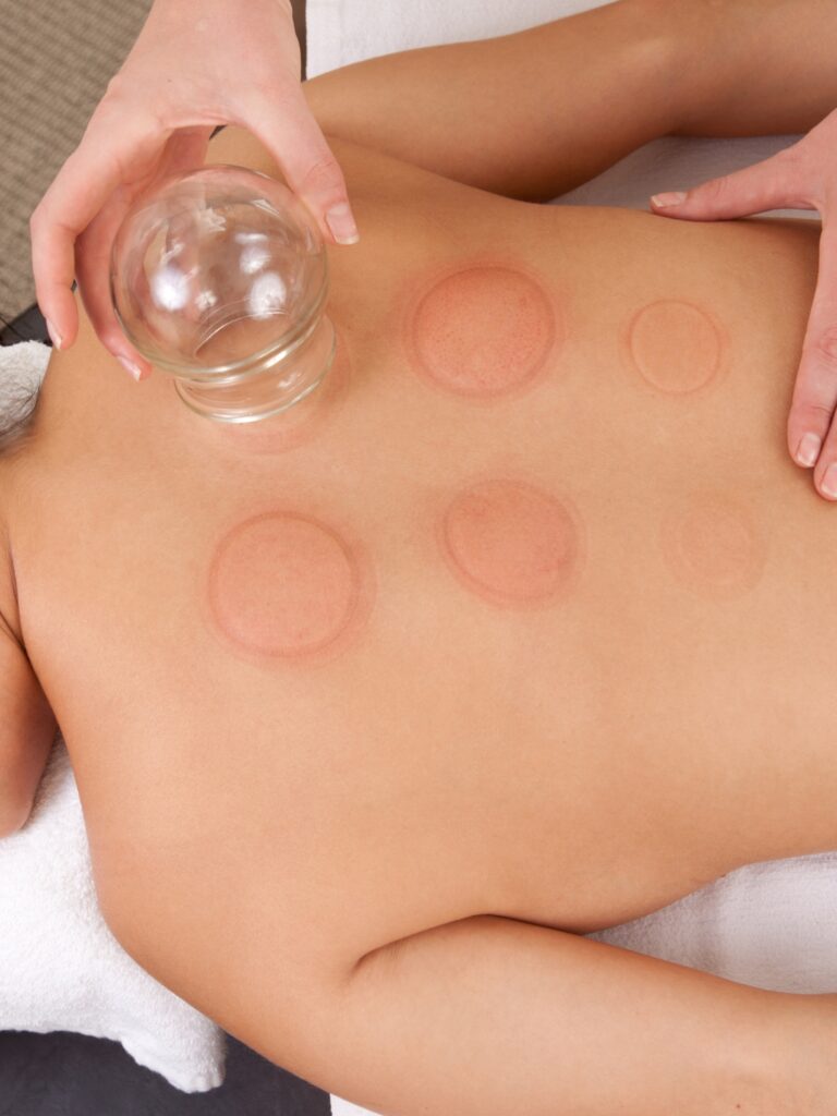 Cupping Therapy Coquitlam