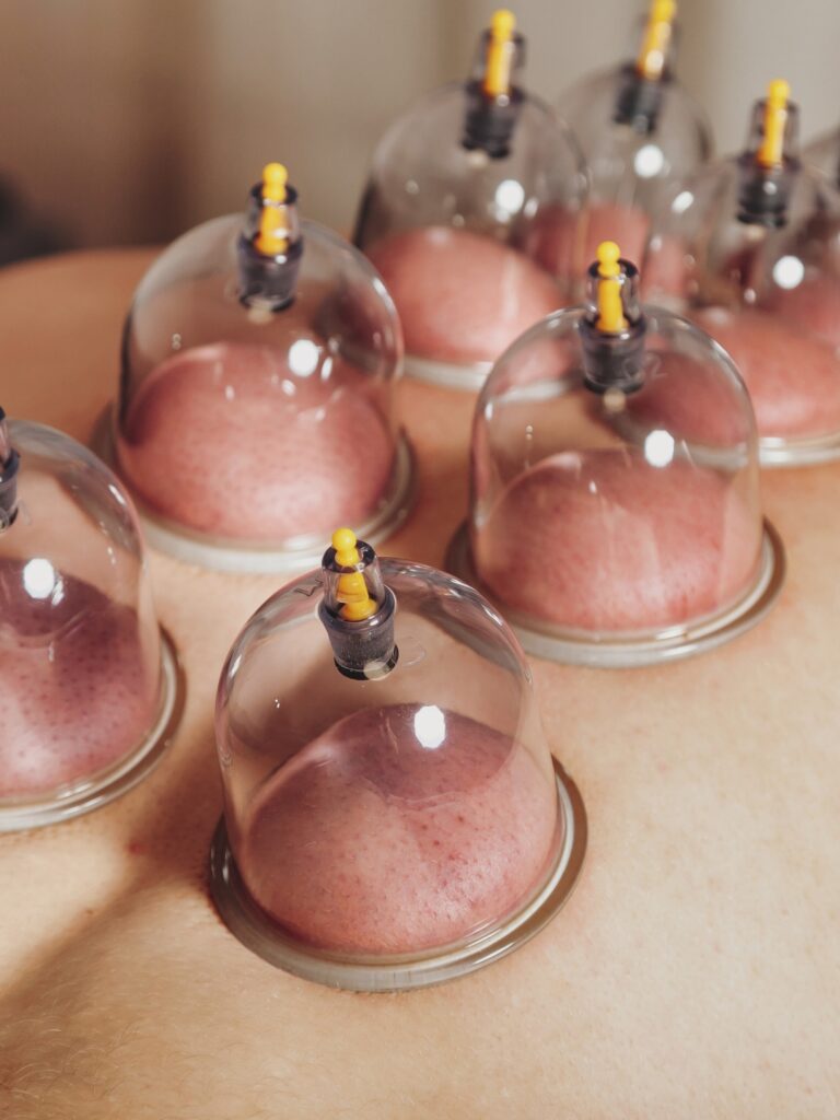 Cupping Therapy in Coquitlam